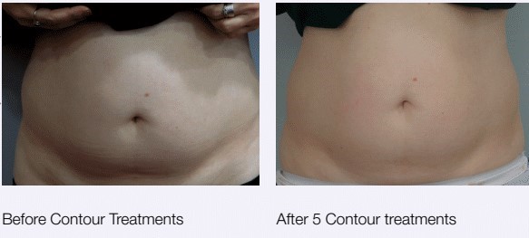 Rf Skin Tightening, Female Belly. Body Of Woman, Cosmetology Procedure. Body  Contouring And Cellulite Reduction. Stock Photo, Picture and Royalty Free  Image. Image 84800511.
