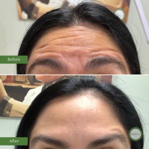Before and After Results - Neuromodulator for the forehead lines