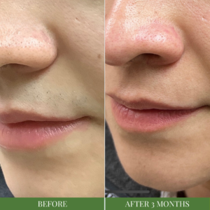 Laser Hair Removal Results of Upper Lip in McAllen