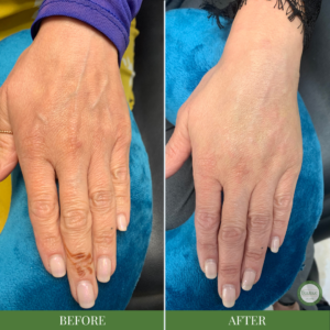 Hand Skin Rejuvenation Results with Beautique Medical Spa