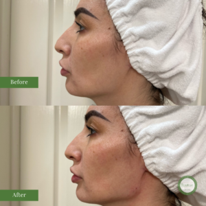 Contouring of the Jawline with RHA Dermal Filler in McAllen, TX
